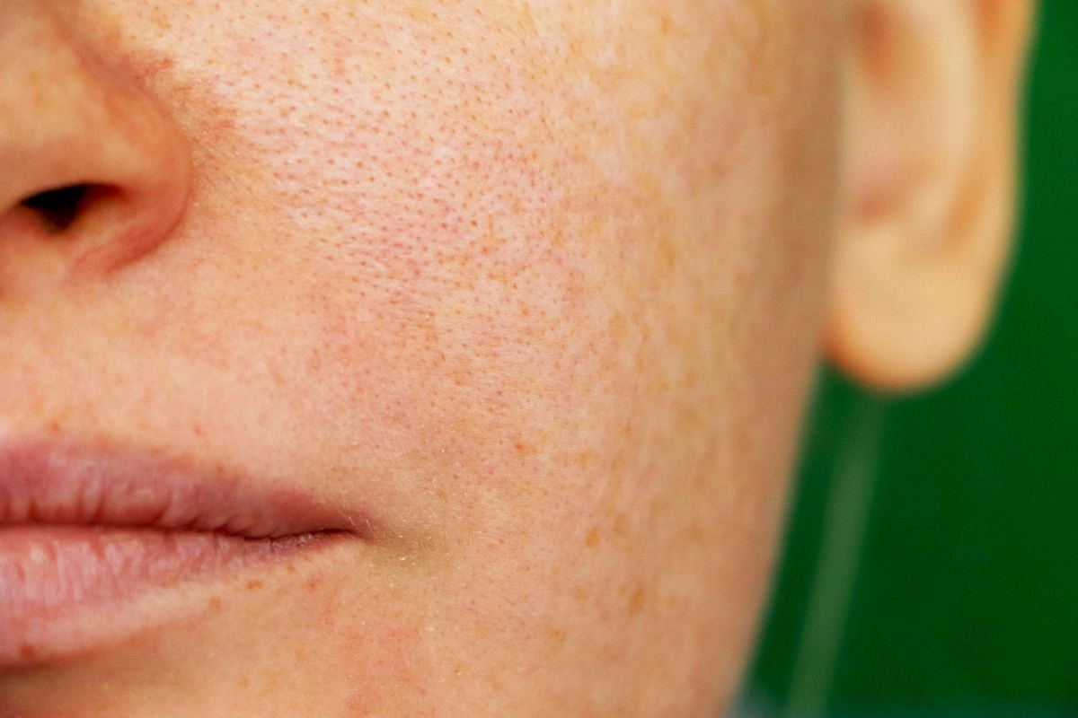 Hyper-Pigmentation Skin Face Treatment in Jaipur
