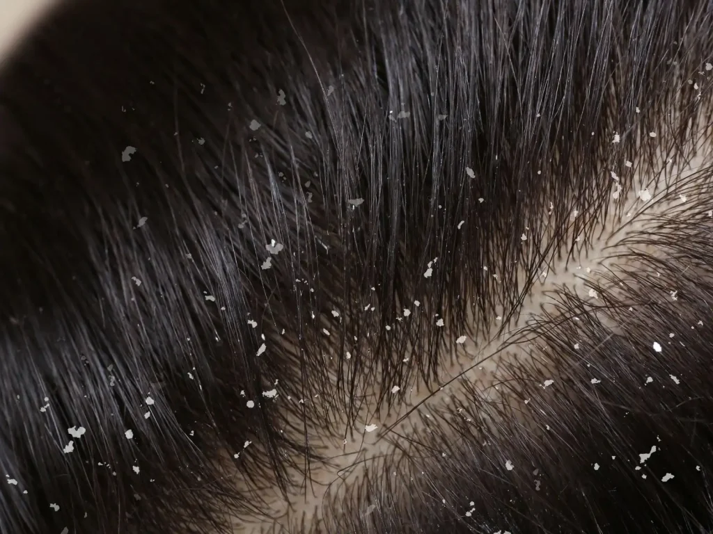 Hair Dandruff Treatment in Salon